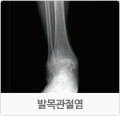 발목관절염 엑스레이 사진